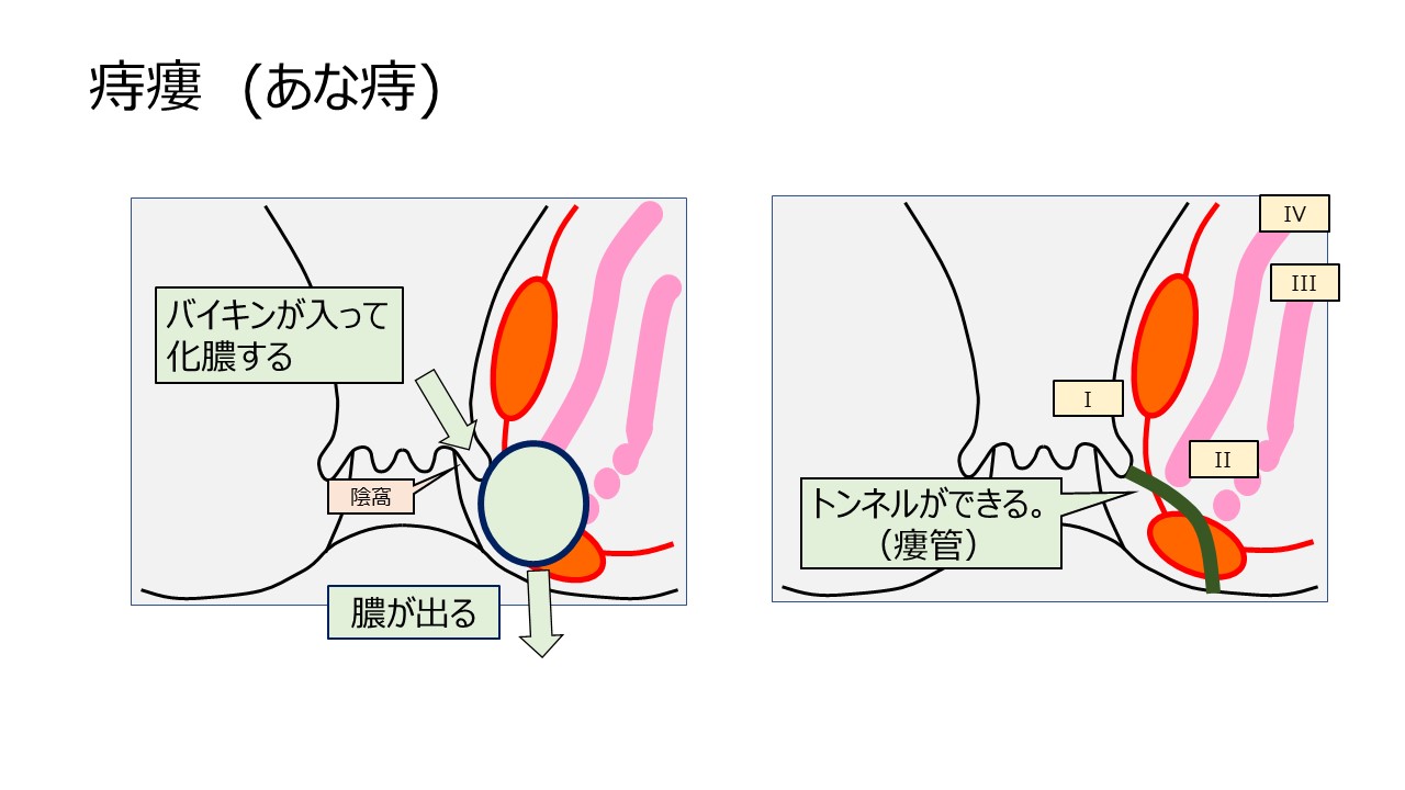 痔瘻 手術 しない で 治っ た